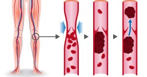 حقائق حول متلازمة مابعد الجلطة