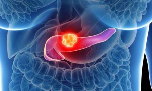 حول تكيسات البنكرياس