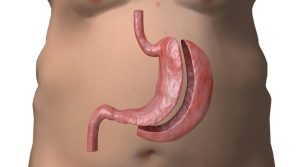 حول عملية تكميم المعدة