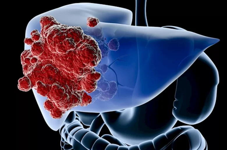سرطان القولون المنتشر في الكبد