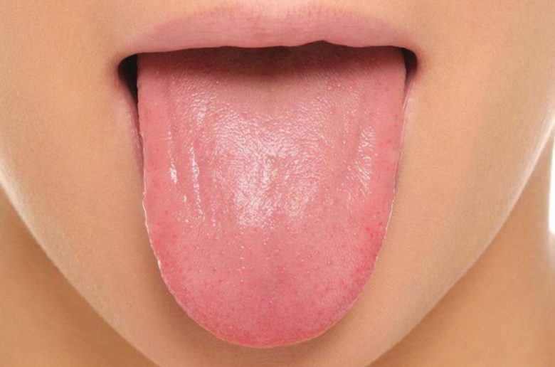 علامات على اللسان للكشف عن نقص الحديد