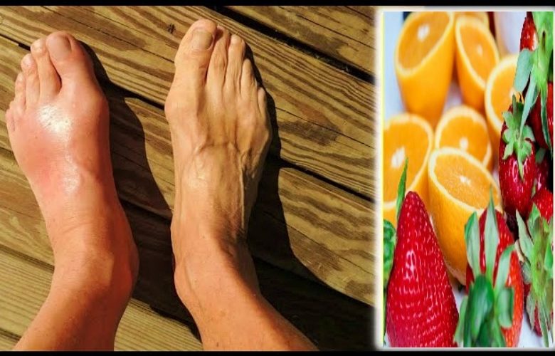 فواكه يجب تناولها عند المعاناة من ارتفاع حمض اليوريك