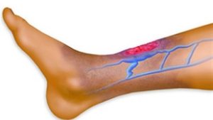 قصور الدورة الدموية