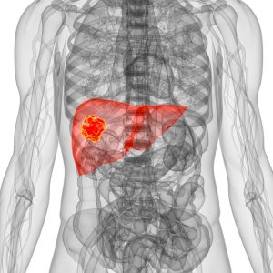 كيفية انتقال سرطان القولون إلى الكبد