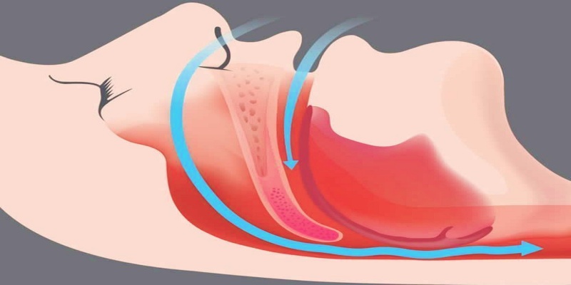 ما تعني أزمة الشخير؟