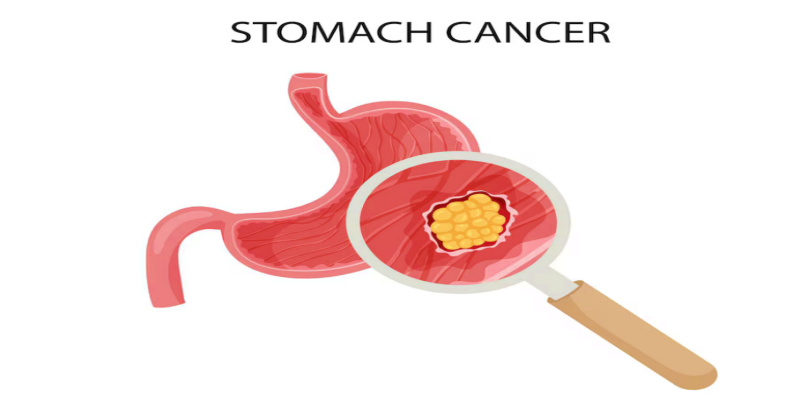 ما هي مراحل سرطان المعدة؟