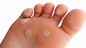 ماهو الكالو ؟