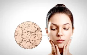 ماهو نقص الفيتامينات المسبب لجفاف الجلد ؟