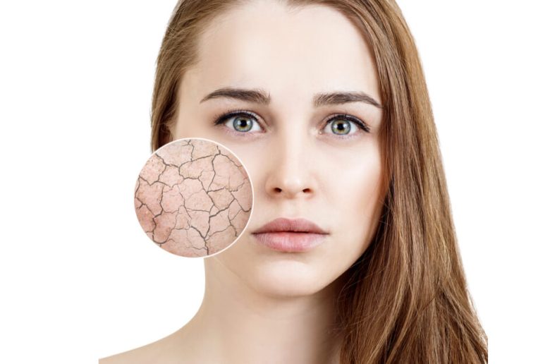 ماهو نقص الفيتامينات المسبب لجفاف الجلد ؟