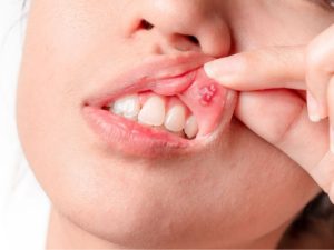 متى تكون التقرحات الفموية علامة تحذيرية على أمراض المناعة الذاتية ؟