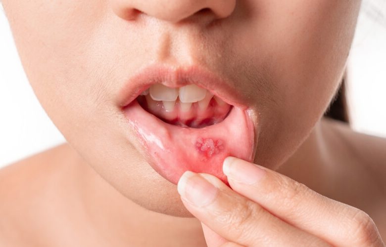 متى تكون التقرحات الفموية علامة تحذيرية على أمراض المناعة الذاتية ؟