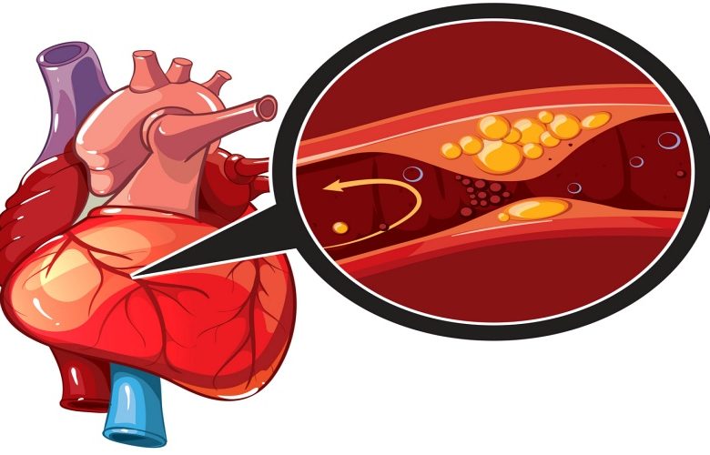 مخاطر الإصابة باللويحات الشريانية وطرق التعرف على هذا الأمر