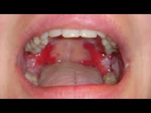 مرض الفقاع الشائع