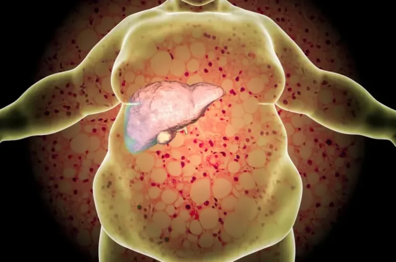 مرض الكبد الدهني المرتبط بخلل التمثيل الغذائي