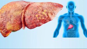 مصادر لأطعمة ممنوع تناولها نيئة لمرضى الكبد الدهني