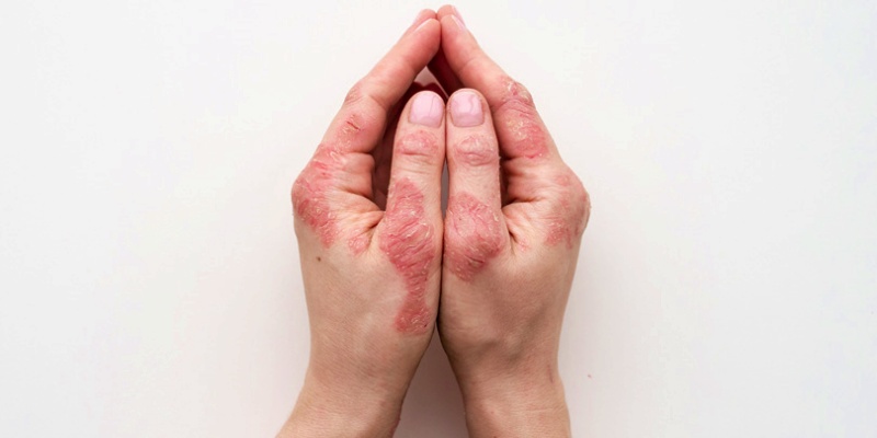 مضاعفات الذئبة الحمراء الجهازية