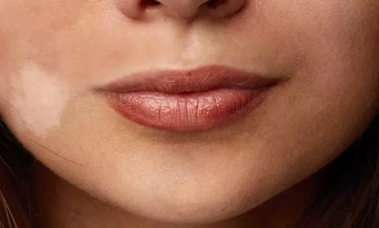 نقص الفيتامينات المؤدي لظهور بقع بيضاء على الجلد