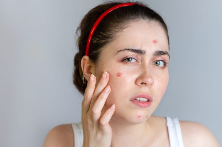 آلية استخدام المضادات الحيوية في علاج الدمامل