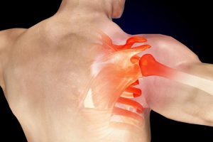 الأسباب المحتملة لإنحشار الكتف