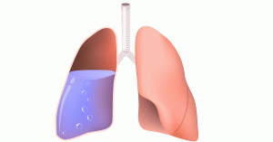 الأمراض تؤدي إلى مضاعفات ارتشاح الماء على الرئة