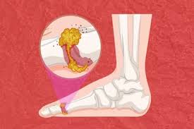 الترسبات البلورية