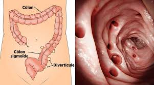 التهاب الرتج