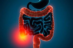 التهابات القولون