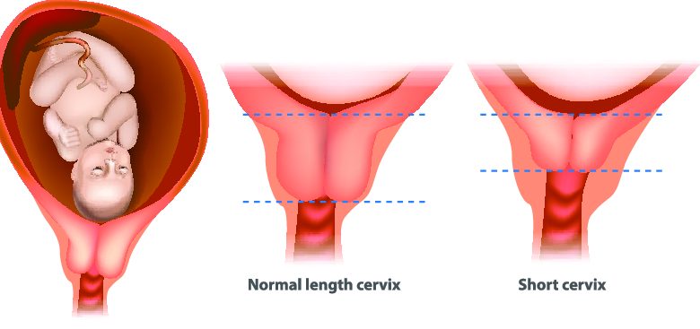 الطول المثالي لعنق الرحم أثناء الحمل