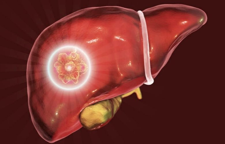 الورم الدموي الكبدي: أسبابه وأهم الأعراض وأنماط العلاج