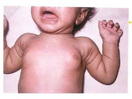 حان وقت استشارة الطبيب لحالات تثدي الرضع