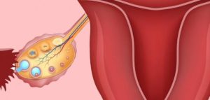 ضعف جودة البويضات