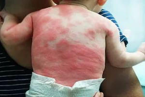 علامات تحذيرية تجعل من التقشر أمرا مقلقا