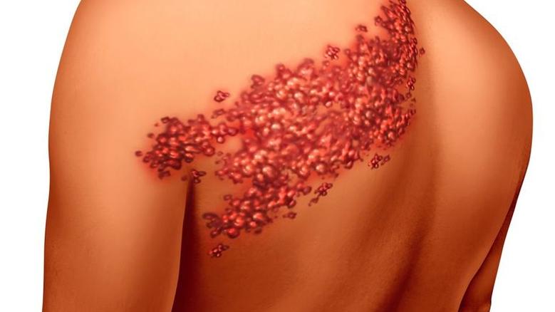 علامات دالة على قرب التعافي من الحزام الناري