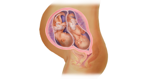 فئات أكثر عرضة لقصر عنق الرحم