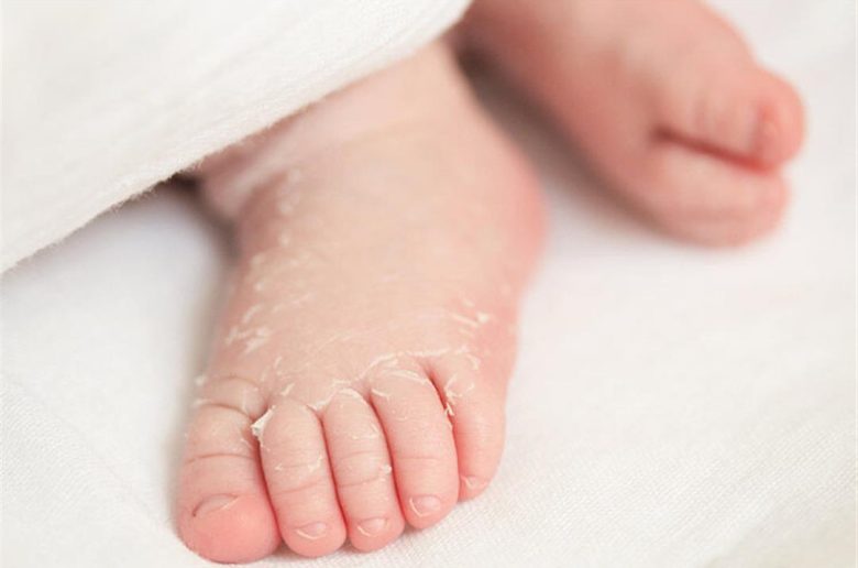 كم تستمر عملية تقشر جلد المواليد الجدد؟