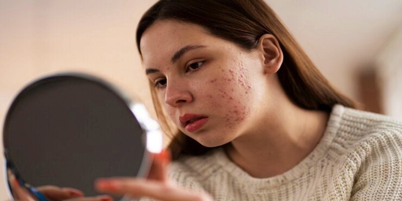 كيف يؤثر الشتاء على البشرة المعرضة لحب الشباب؟