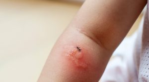 لدغات البعوض لدى الأطفال