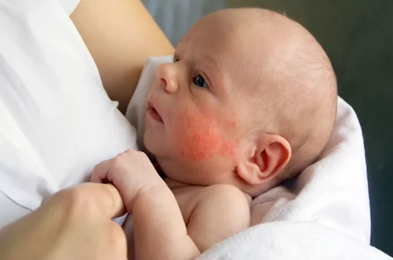 لدغات البعوض لدى الأطفال