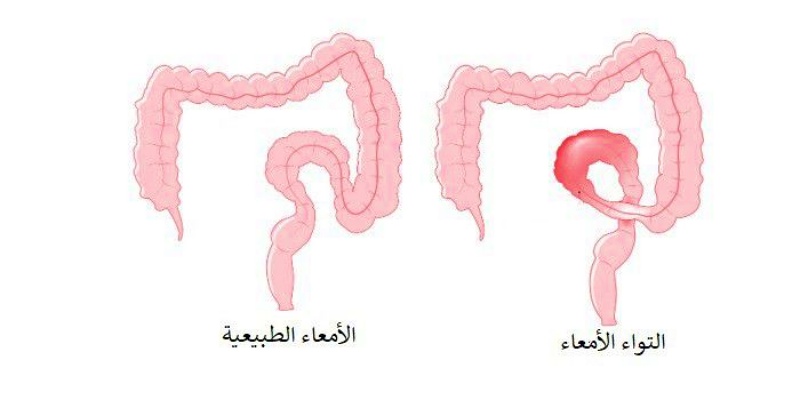 ما المقصود بالتواء المعدة عند الأطفال؟