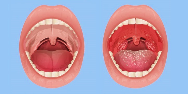 ما هي أسباب الإصابة بالتهاب البلعوم المزمن؟
