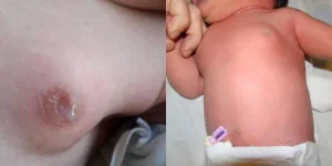 ماالمقصود بالتثدي لدى حديثي الولادة ؟