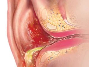 ماذا تعني عدوى الأذن الخارجية ؟