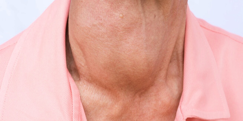 ماذا نعني بفرط نشاط الغدة الدرقيةوأهم أعراضها؟