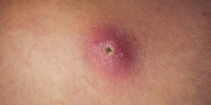 ماذا يعني الدمل ؟