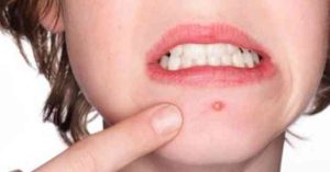 ماهي آلية استخدام المضادات الحيوية في علاج الدمامل ؟