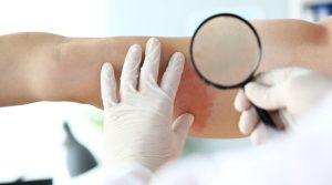 ماهي المدة المتوقعة لعلاج الحزام الناري ؟