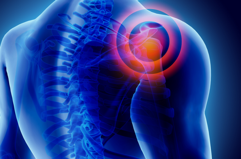 متلازمة انحشار الكتف