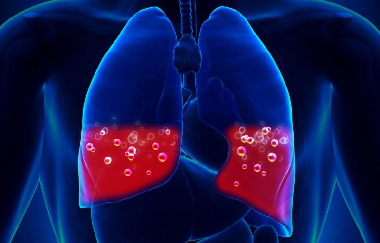 مضاعفات ارتشاح الماء على الرئة