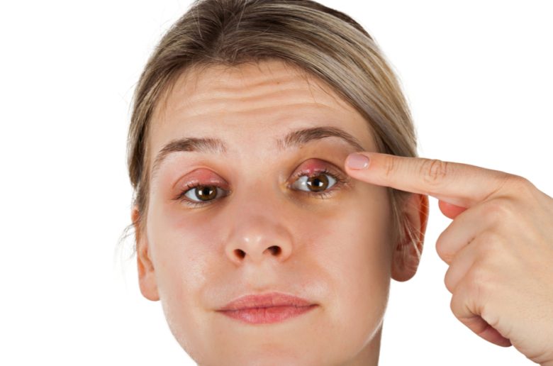 ممارسات شائعة تؤدي إلى الإصابة بالكيس الدهني في العيون