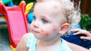 هل الأطفال الرضع لديهم مناعة ذاتية ضد لدغات البعوض؟